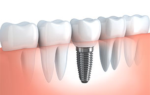 Dental Implants